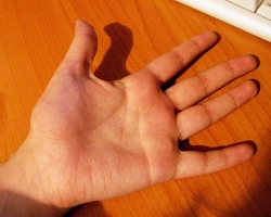 По ладони человека возможно предсказать рак  По ладони человека возможно предсказать рак