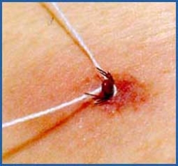 24 тысячи человек в Беларуси были укушены клещами с начала года 24 тысячи человек в Беларуси были укушены клещами с начала года